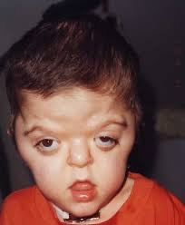 ¿Qué es el síndrome de Apert?