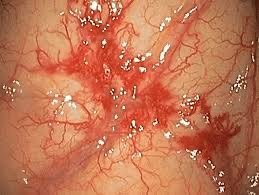 ¿Cuáles son las anomalías vasculares del tubo digestivo?