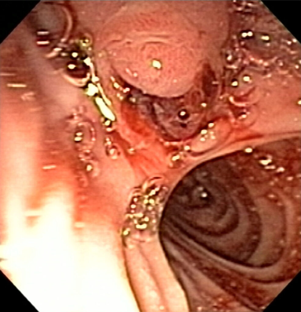¿Qué es la hemobilia