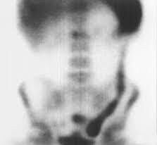 Gammagrafía con eritrocitos marcados con tecnecio-99m