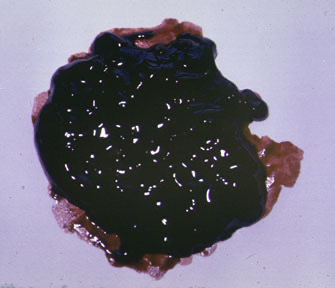 Diferencia entre melena y hematoquezia