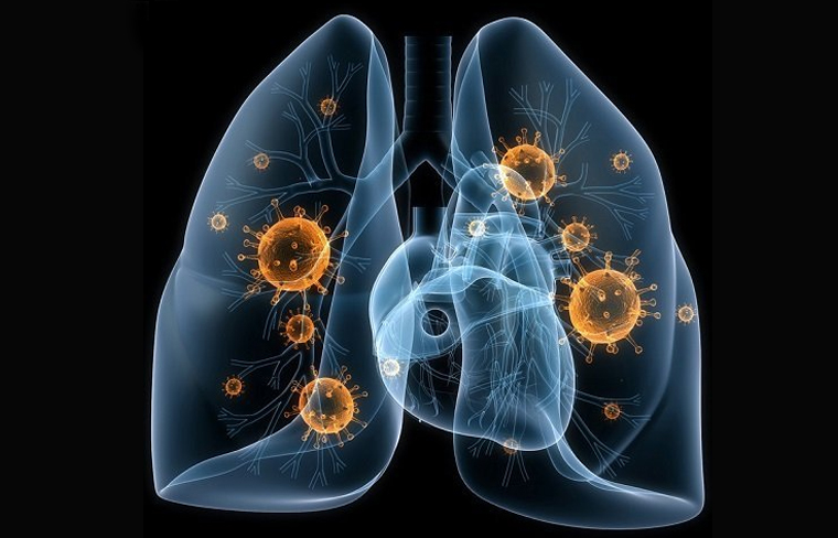 Clasificación de las neumonías