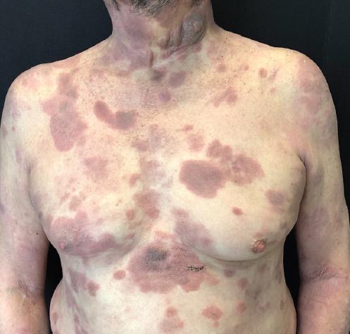 ¿Qué es la micosis fungoide?