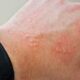 Causas de dermatitis por contacto