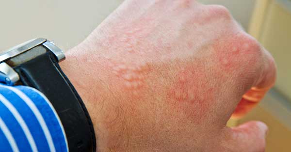Causas de dermatitis por contacto