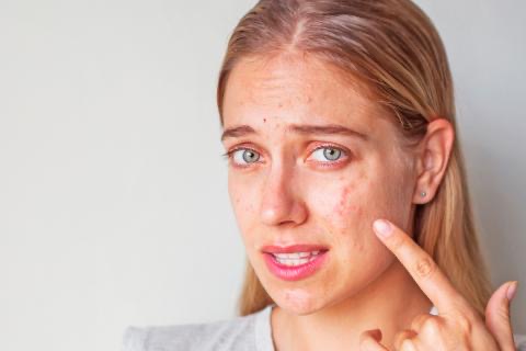 Acné resistente a tratamiento en mujeres
