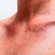 ¿Como se clasifica la fotodermatosis?