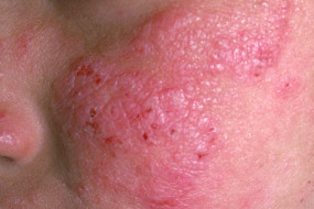 ¿Cuáles son las fotodermatosis primarias?