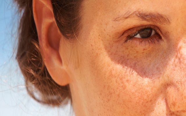 Fotodermatitis causada por químicos