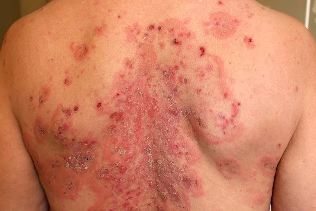 ¿Qué es el pénfigo?