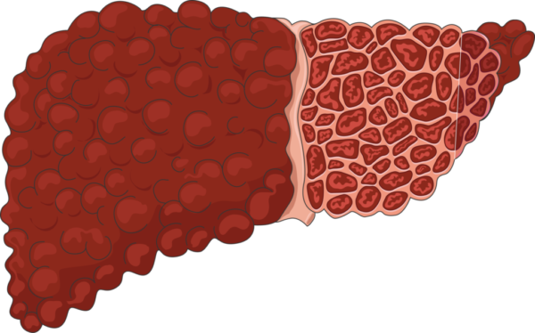 Estadificación de la cirrosis hepática