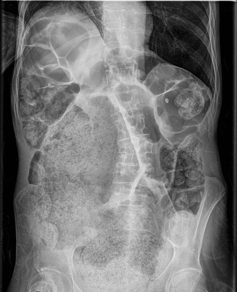 ¿Qué es la coproestasis?