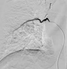 adminostración intraarterial de fármacos