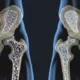 ¿Tiene cura la osteoporosis?