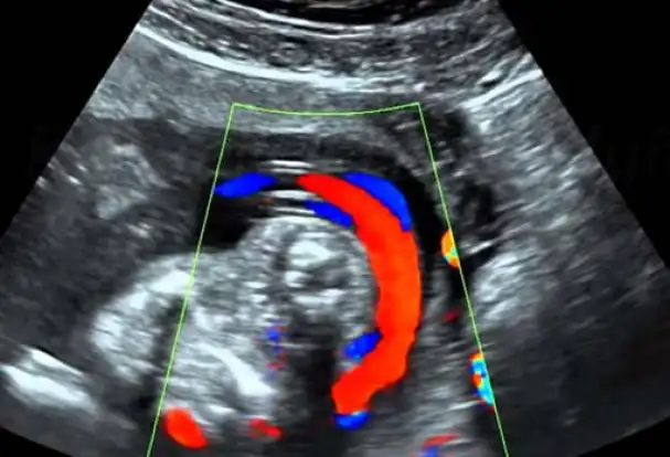 ¿Qué es el ultrasonido doppler?