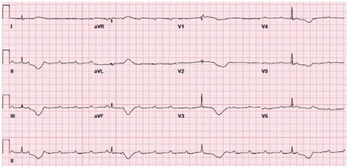 ¿Cuál es el abordaje inicial de pacientes con bradiarritmias?