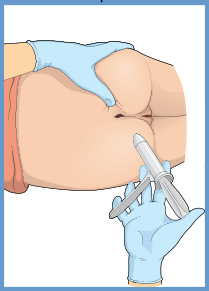 ¿Cómo se realiza una anoscopía?