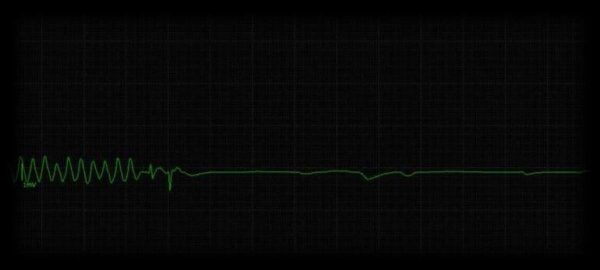 ¿Qué es la asistolia?