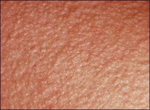 Manifestaciones clínicas de la milaria