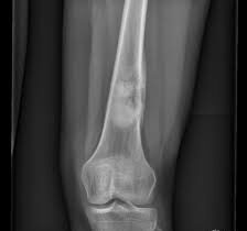 Clasificación del osteosarcoma