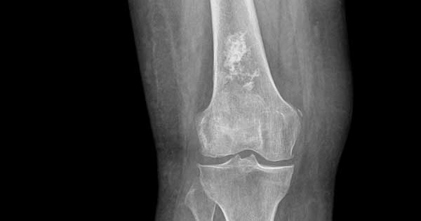 Clasificación del condrosarcoma