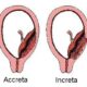 ¿Qué es la placenta accreta?