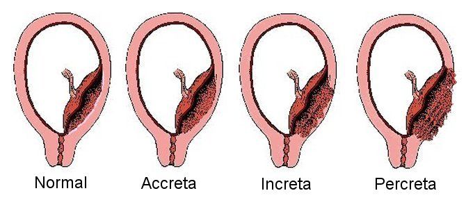 ¿Qué es la placenta accreta?
