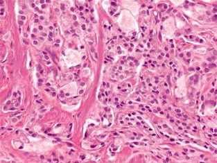 Tipos de cáncer de próstata