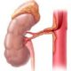 ¿Cuál es la causa mas frecuente de estenosis de arteria renal?