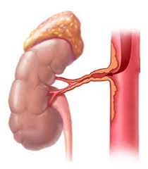 ¿Cuál es la causa mas frecuente de estenosis de arteria renal?