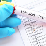 Tratamiento de la hiperuricemia asintomática