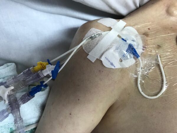 Complicaciones mecánicas de la colocación de catéter venoso central