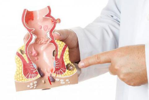 ¿Cuáles son las contraindicaciones para realizar una anoscopía?