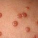 ¿Qué es el molusco contagioso?