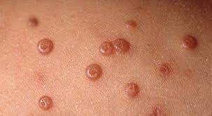 ¿Qué es el molusco contagioso?