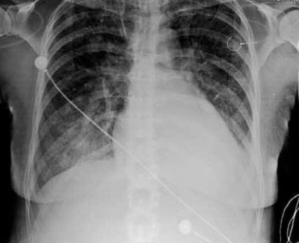 Complicaciones mecánicas de los catéteres venosos centrales