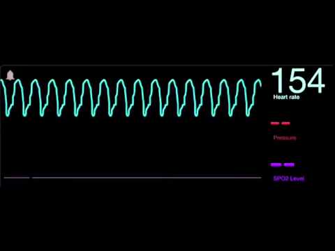 ¿Cómo se define la taquicardia ventricular?