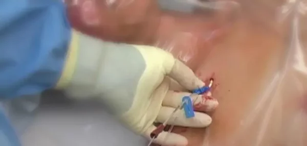 Infección de catéteres venosos