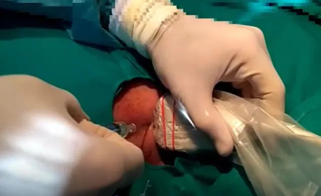 Colocación de catéteres venosos centrales guiada por ecografía