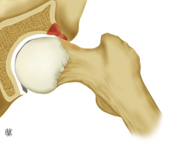 Labrum articular, disco y menisco