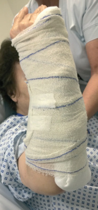 Contraindicaciones de férulas y escayolas