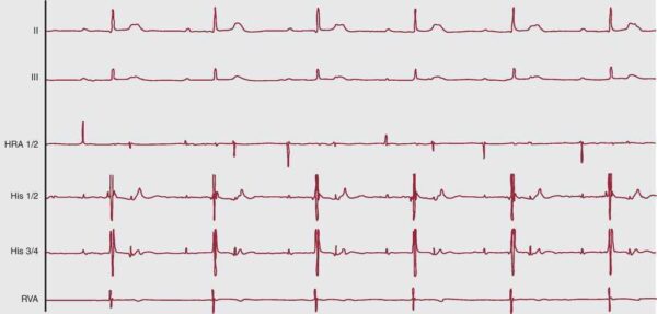 Diagnóstico diferencial de las bradiarritmias