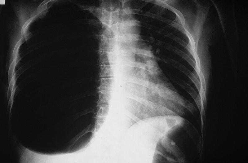 Manejo de neumotórax a tensión