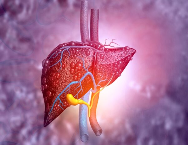 Bilirrubinas en hepatopatía alcohólica