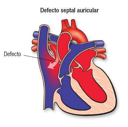 ¿Qué es el defecto del septo auricular?