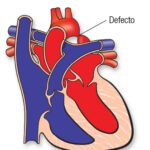 ¿Qué es la coartación de la aorta?