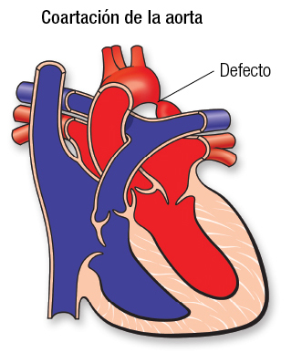 ¿Qué es la coartación de la aorta?