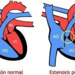 ¿Qué es la estenosis de la válvula pulmonar?
