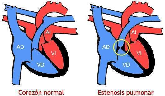¿Qué es la estenosis de la válvula pulmonar?
