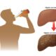 ¿Qué causa el alcohol en el hígado?